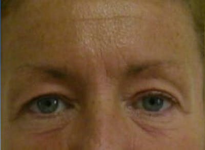 Eye Lift Gallery - Patient 9605859 - Image 1