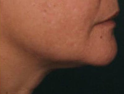 Ultherapy Before & After Gallery - Patient 9605858 - Image 2