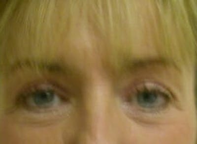 Eye Lift Before & After Gallery - Patient 9605859 - Image 2