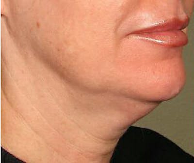 Ultherapy Before & After Gallery - Patient 9605861 - Image 1