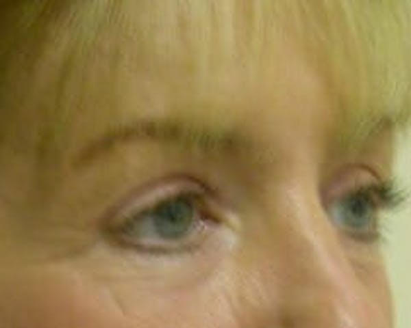 Eye Lift Before & After Gallery - Patient 9605859 - Image 4