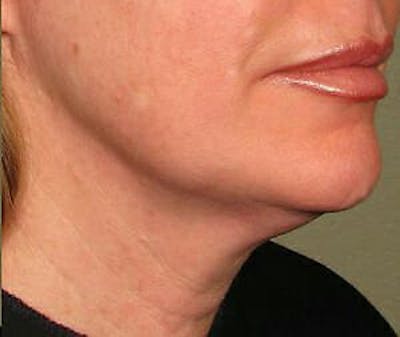 Ultherapy Before & After Gallery - Patient 9605861 - Image 2