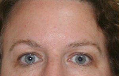Eye Lift Before & After Gallery - Patient 9605863 - Image 1
