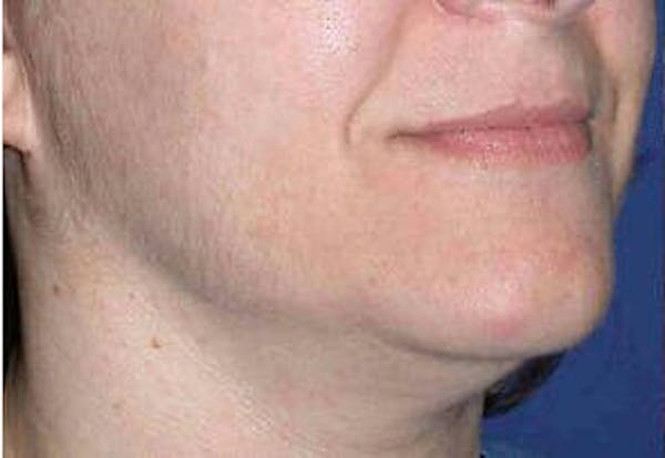 Ultherapy Before & After Gallery - Patient 9605862 - Image 1