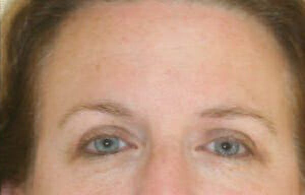 Eye Lift Before & After Gallery - Patient 9605863 - Image 2
