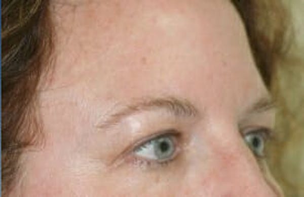 Eye Lift Before & After Gallery - Patient 9605863 - Image 3