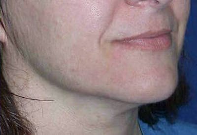 Ultherapy Before & After Gallery - Patient 9605862 - Image 2
