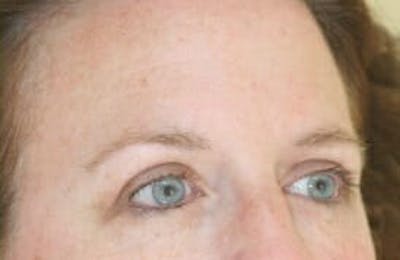 Eye Lift Before & After Gallery - Patient 9605863 - Image 4