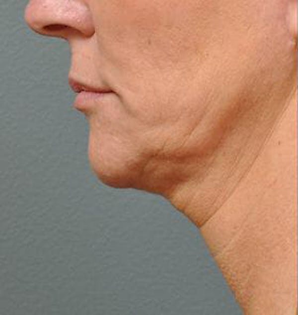 Ultherapy Before & After Gallery - Patient 9605864 - Image 1