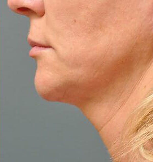 Ultherapy Before & After Gallery - Patient 9605864 - Image 2