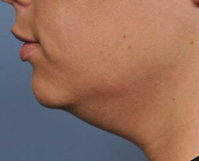 Ultherapy Before & After Gallery - Patient 9605865 - Image 1