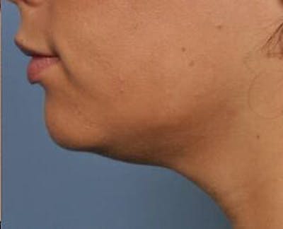 Ultherapy Before & After Gallery - Patient 9605865 - Image 2