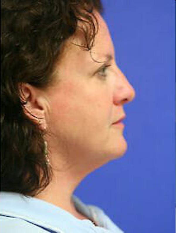 Ultherapy Before & After Gallery - Patient 9605866 - Image 6