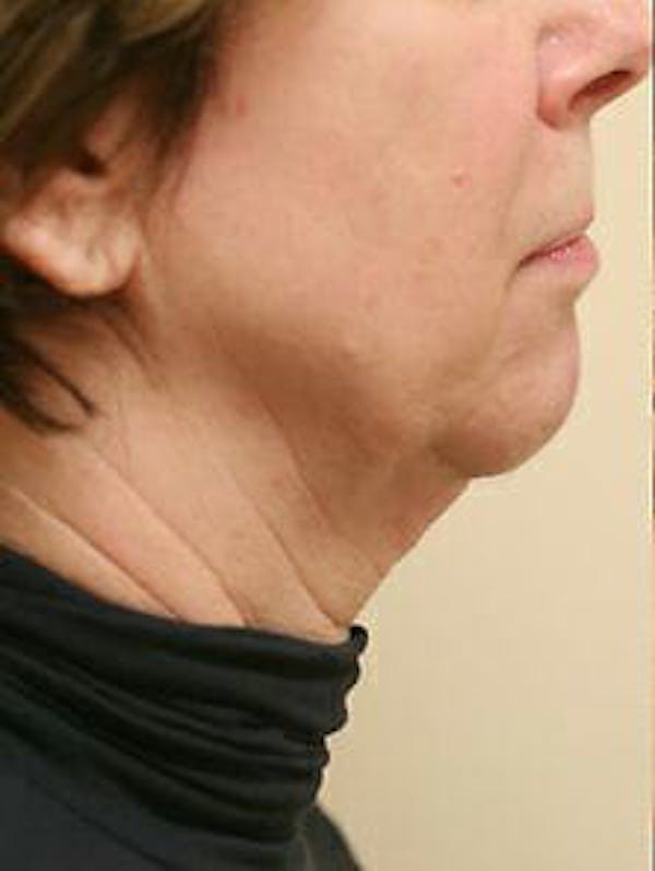 Ultherapy Before & After Gallery - Patient 9605867 - Image 1