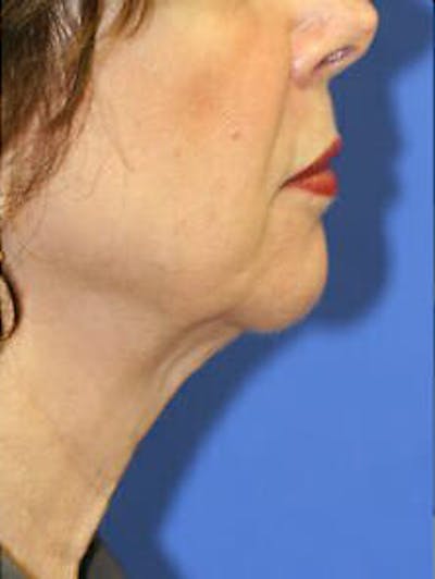 Ultherapy Before & After Gallery - Patient 9605867 - Image 2