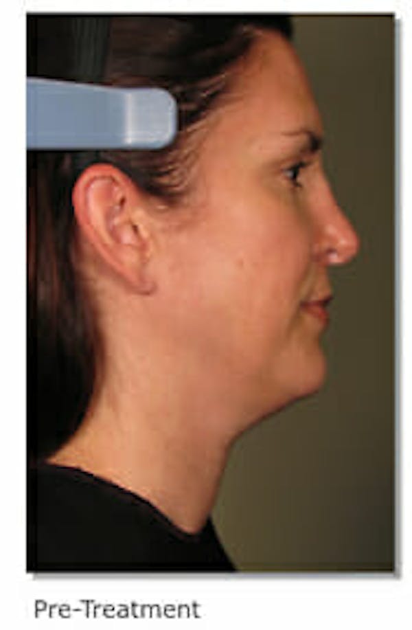 Ultherapy Gallery - Patient 9605869 - Image 1