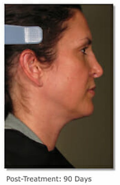 Ultherapy Gallery - Patient 9605869 - Image 2
