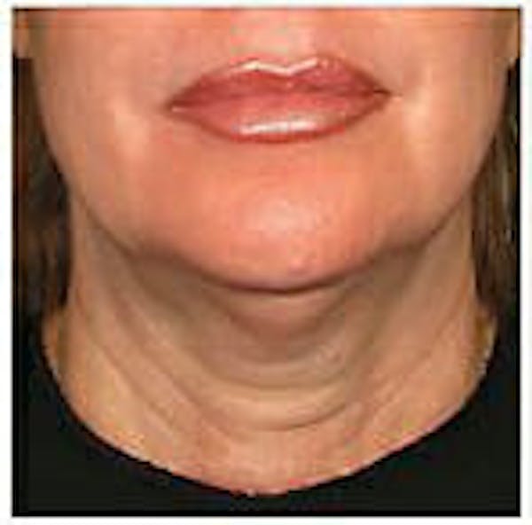 Ultherapy Before & After Gallery - Patient 9605870 - Image 1