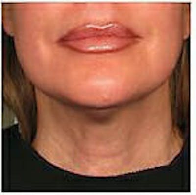 Ultherapy Before & After Gallery - Patient 9605870 - Image 2