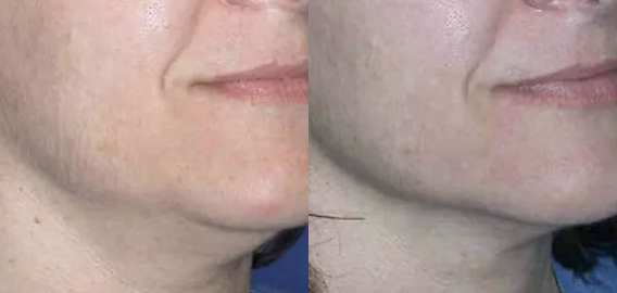 Ultherapy Before and After - 2