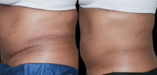 Coolsculpting before and after - 4