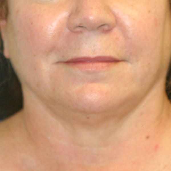 Chin & Neck Liposuction Before & After Gallery - Patient 93282036 - Image 1