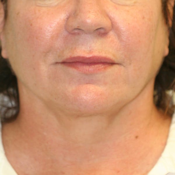 Chin & Neck Liposuction Before & After Gallery - Patient 93282036 - Image 2