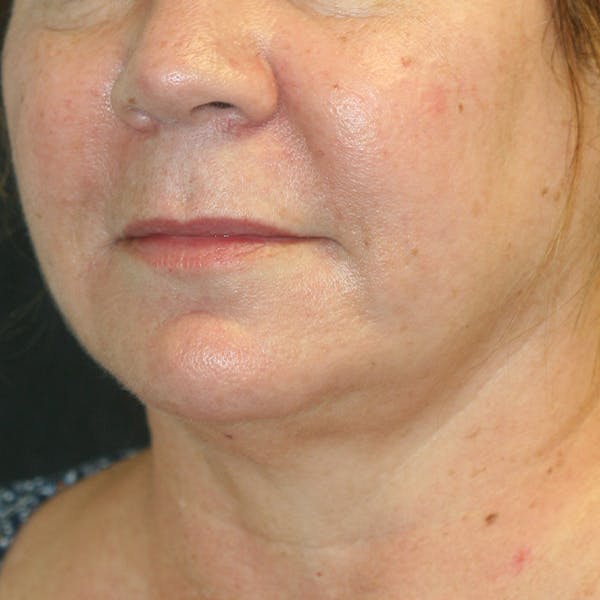 Chin & Neck Liposuction Before & After Gallery - Patient 93282036 - Image 3