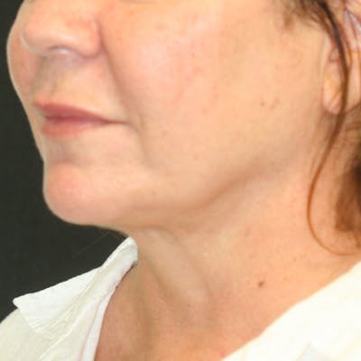 Chin & Neck Liposuction Gallery - Patient 93282036 - Image 4