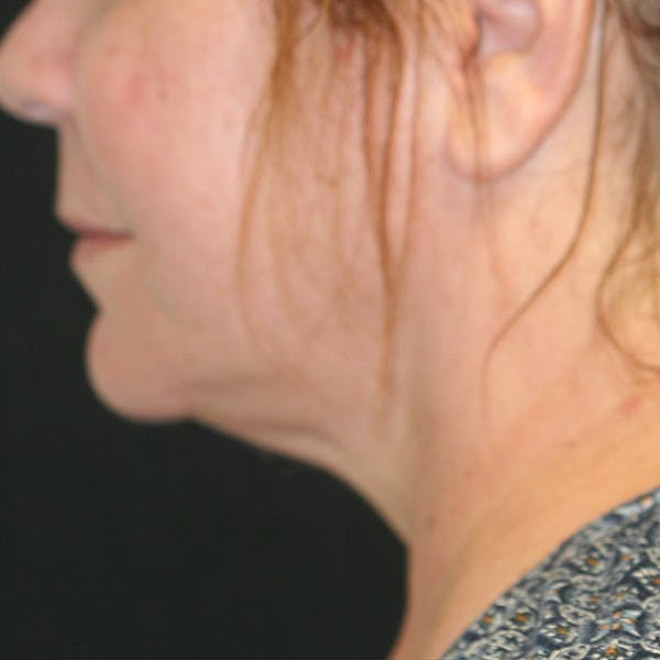 Chin & Neck Liposuction Gallery - Patient 93282036 - Image 5
