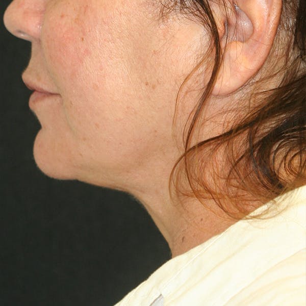 Chin & Neck Liposuction Before & After Gallery - Patient 93282036 - Image 6