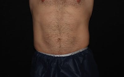 CoolSculpting® Before & After Gallery - Patient 94080526 - Image 2
