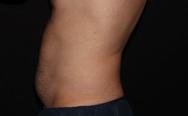 CoolSculpting® Elite Before & After Gallery - Patient 94080526 - Image 5