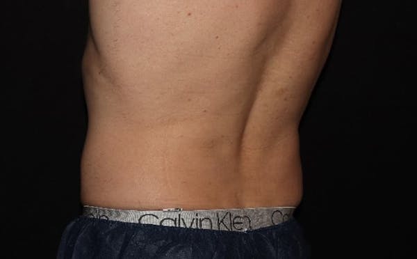 CoolSculpting® Elite Before & After Gallery - Patient 94080526 - Image 8