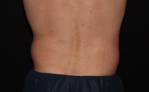 CoolSculpting® Elite Before & After Gallery - Patient 94080526 - Image 9