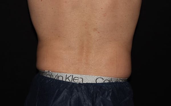CoolSculpting® Elite Before & After Gallery - Patient 94080526 - Image 10