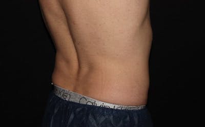 CoolSculpting® Gallery - Patient 94080526 - Image 12