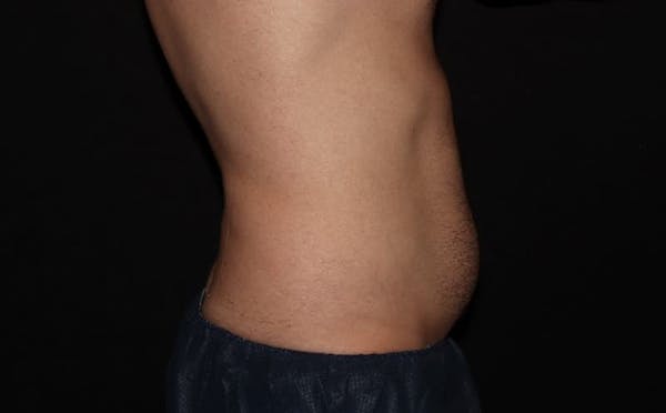 CoolSculpting® Elite Before & After Gallery - Patient 94080526 - Image 13