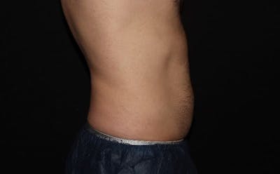 CoolSculpting® Elite Before & After Gallery - Patient 94080526 - Image 14