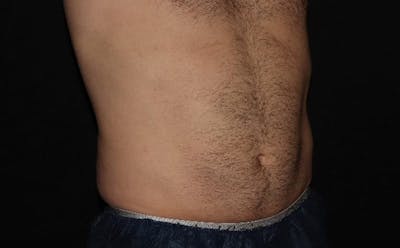 CoolSculpting® Elite Before & After Gallery - Patient 94080526 - Image 16