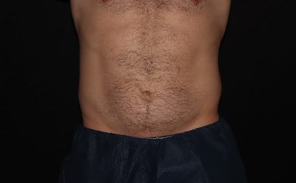 CoolSculpting® Elite Before & After Gallery - Patient 94080526 - Image 1