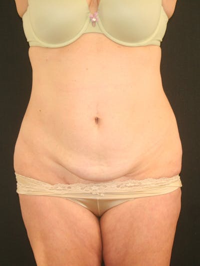 Tummy Tuck Before & After Gallery - Patient 118537548 - Image 1