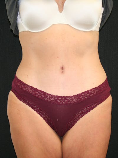 Tummy Tuck Before & After Gallery - Patient 118537548 - Image 2