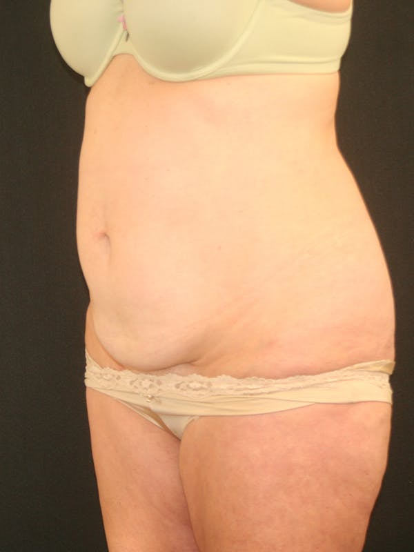 Tummy Tuck Before & After Gallery - Patient 118537548 - Image 3