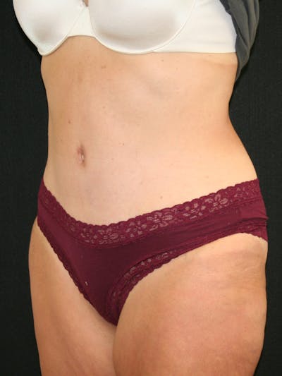 Tummy Tuck Before & After Gallery - Patient 118537548 - Image 4