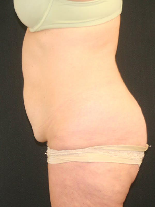 Tummy Tuck Before & After Gallery - Patient 118537548 - Image 5