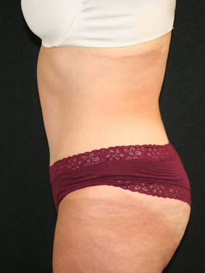 Tummy Tuck Before & After Gallery - Patient 118537548 - Image 6