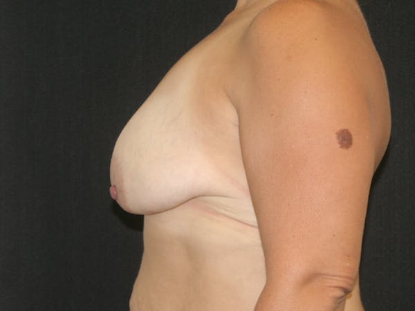 Mastopexy Before & After Gallery - Patient 120948232 - Image 5