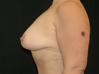 Mastopexy Before & After Gallery - Patient 120948232 - Image 6