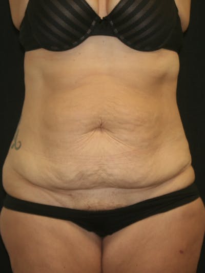 Tummy Tuck Before & After Gallery - Patient 120948243 - Image 1